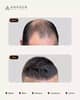 Slider image (8) Anagen - Hair Transplant Clinic in Switzerland
